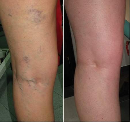 żylaki, pajączki, teleangiektazje, skleroterapia, operacje żylaków