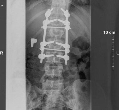 operacja guza mózgu