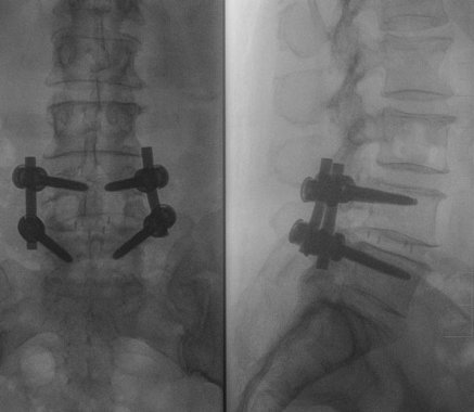 złamanie kości czaszki
