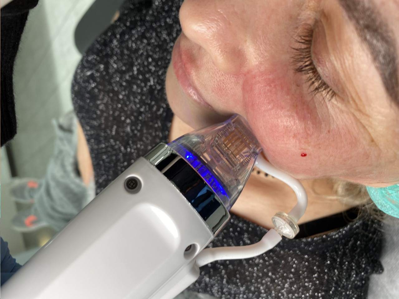 zabiegi medycyny estetycznej