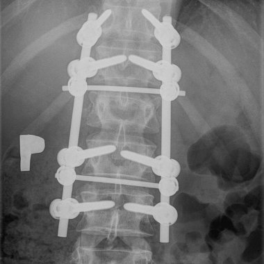 operacja dyskopatii szyjnej