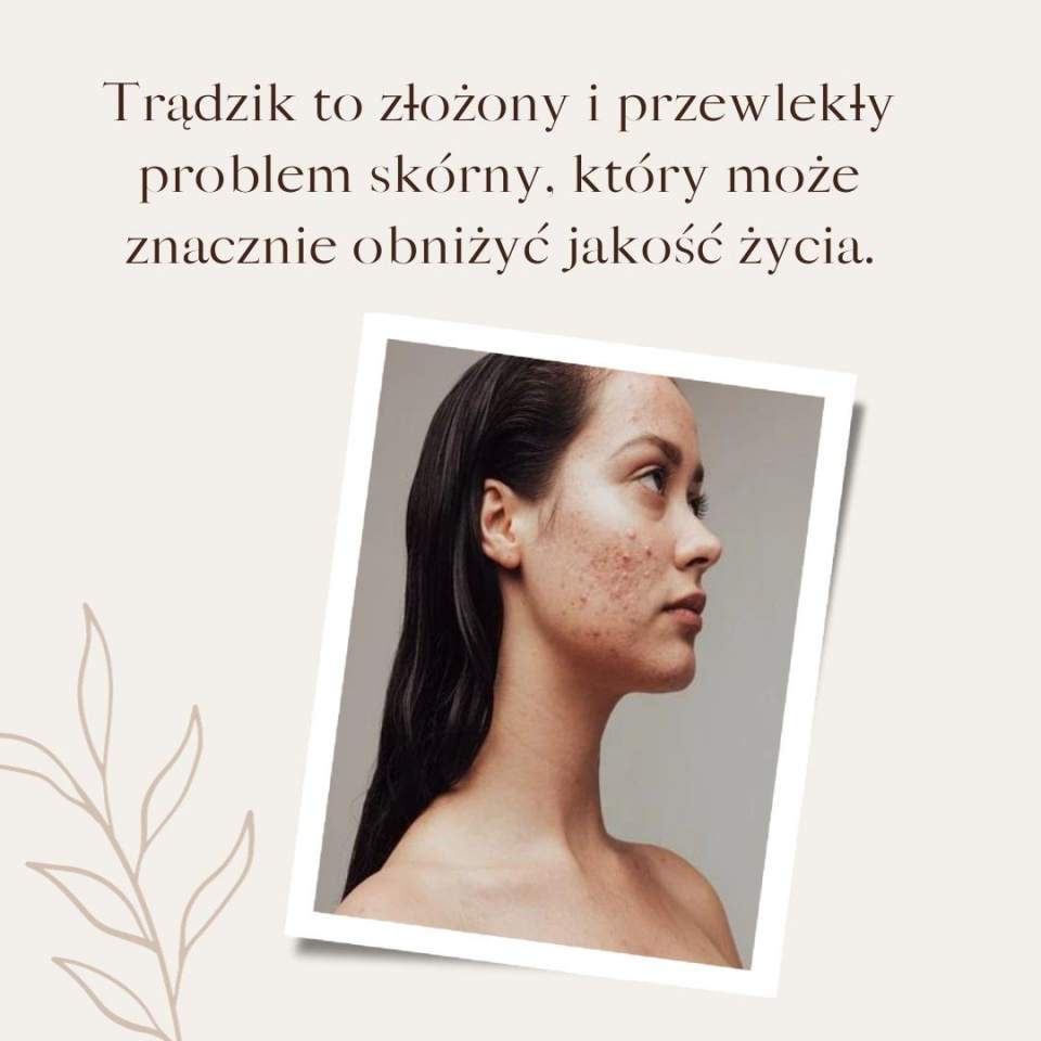 trądzik