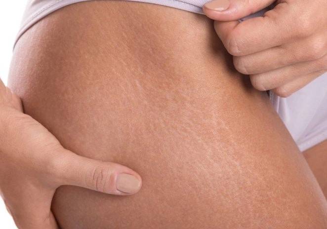 redukcja rozstępów