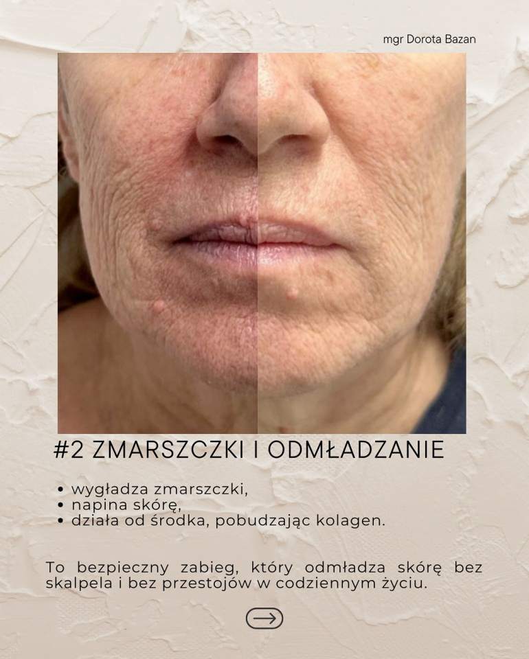 Dorota Bazan Piękno Estetyczne usuwanie zmarszczek