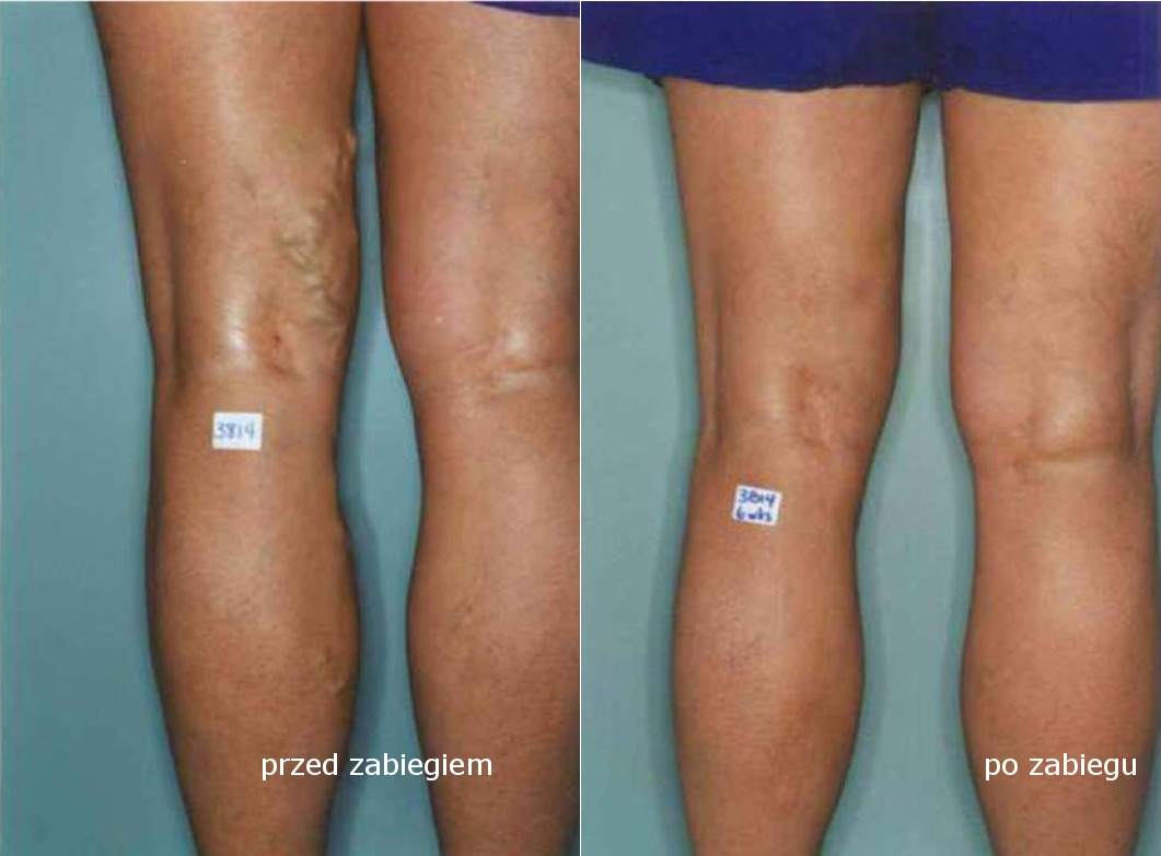 Laserowe usuwanie żylaków