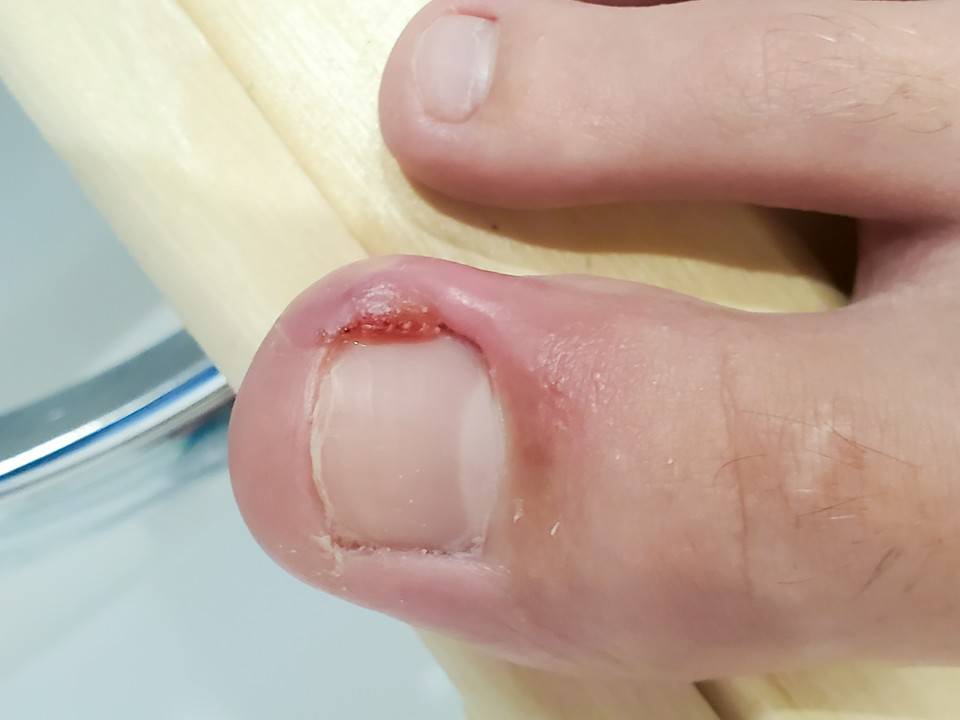 leczenie wrastających paznokci