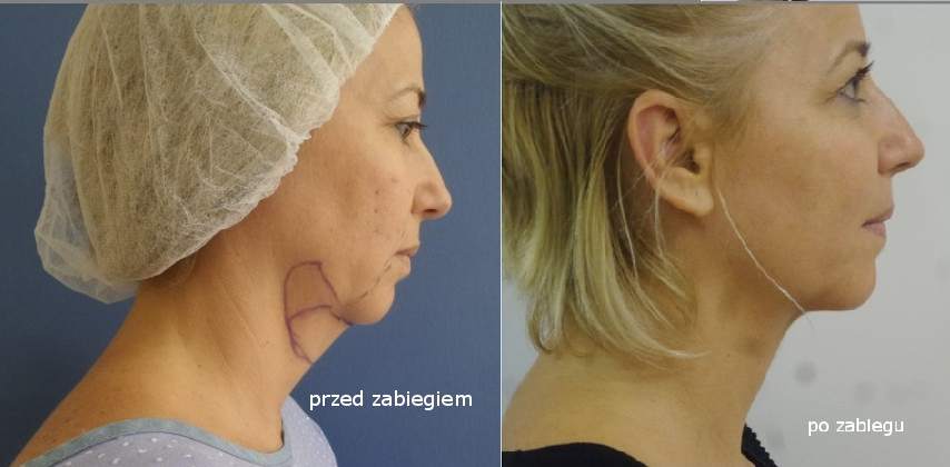 Liposukcja Podbródek