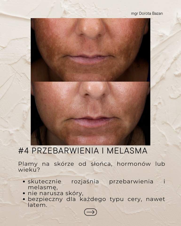 Dorota Bazan Piękno Estetyczne usuwanie przebarwień