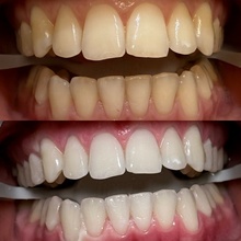 laserowe wybielanie zębów