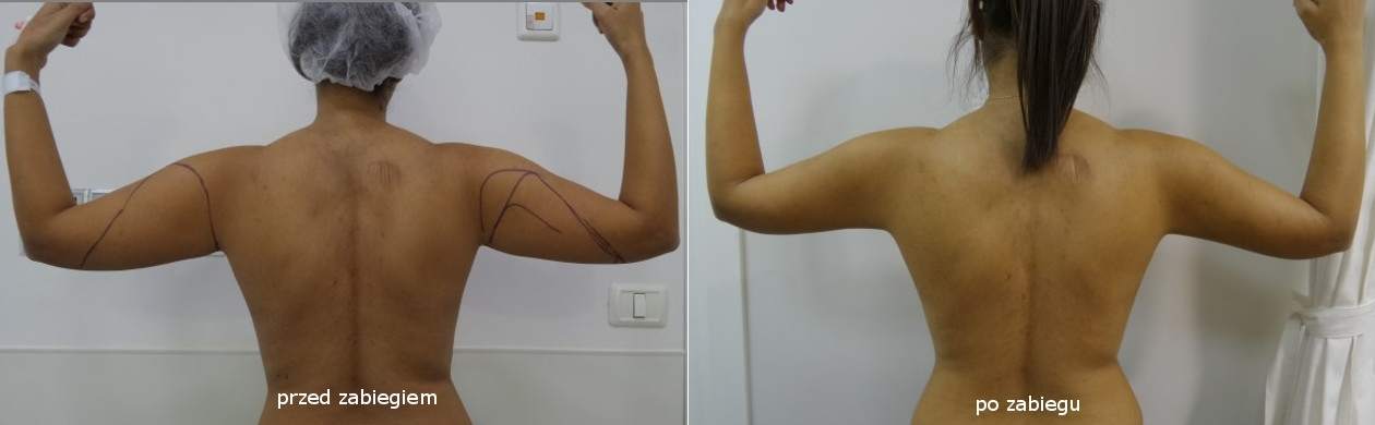 Liposukcja Ramiona