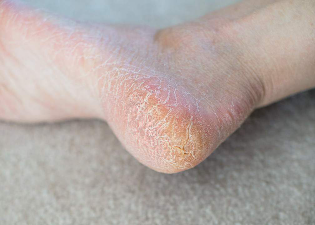 leczenie pękających pięt