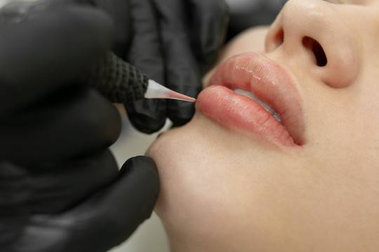 microneedling
