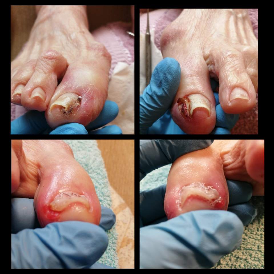 wrastające paznokcie