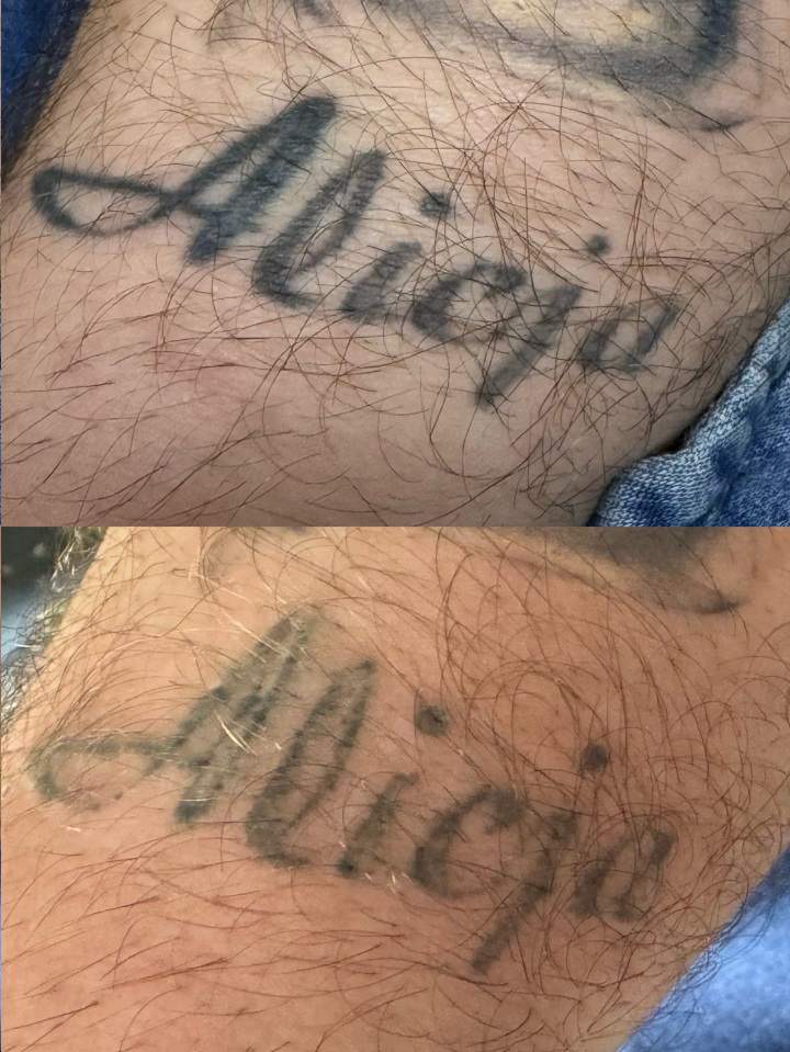 Laserowe usuwanie tatuażu