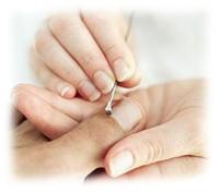 korekta wrastających paznokci