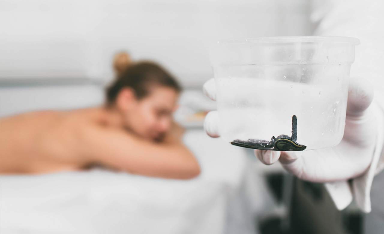 terapia pijawkami leczniczymi