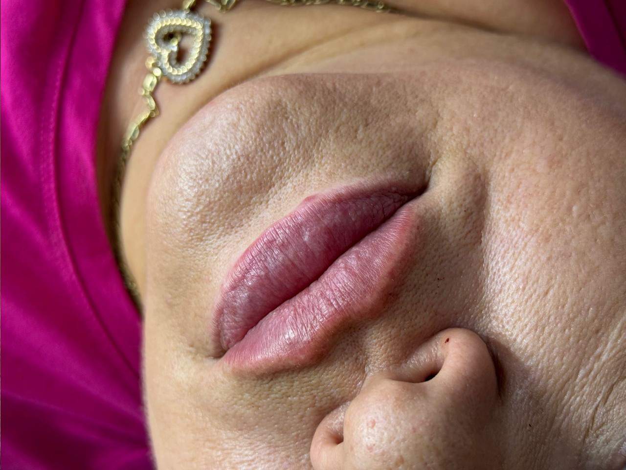 Modelowanie ust kwasem hialuronowym