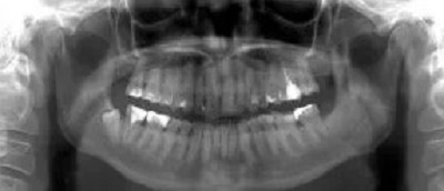 zdjęcie pantomograficzne