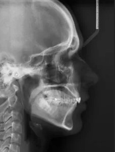 zdjęcie cefalometryczne