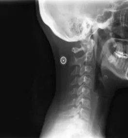 zdjęcie kręgosłupa szyjnego