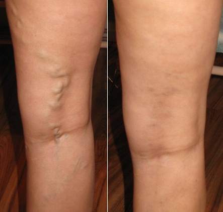 żylaki, pajączki, teleangiektazje, skleroterapia, operacje żylaków