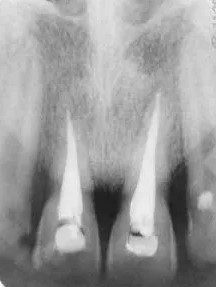 zdjęcie punktowe zębów