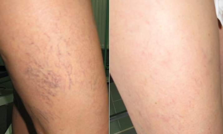 żylaki, pajączki, teleangiektazje, skleroterapia, operacje żylaków