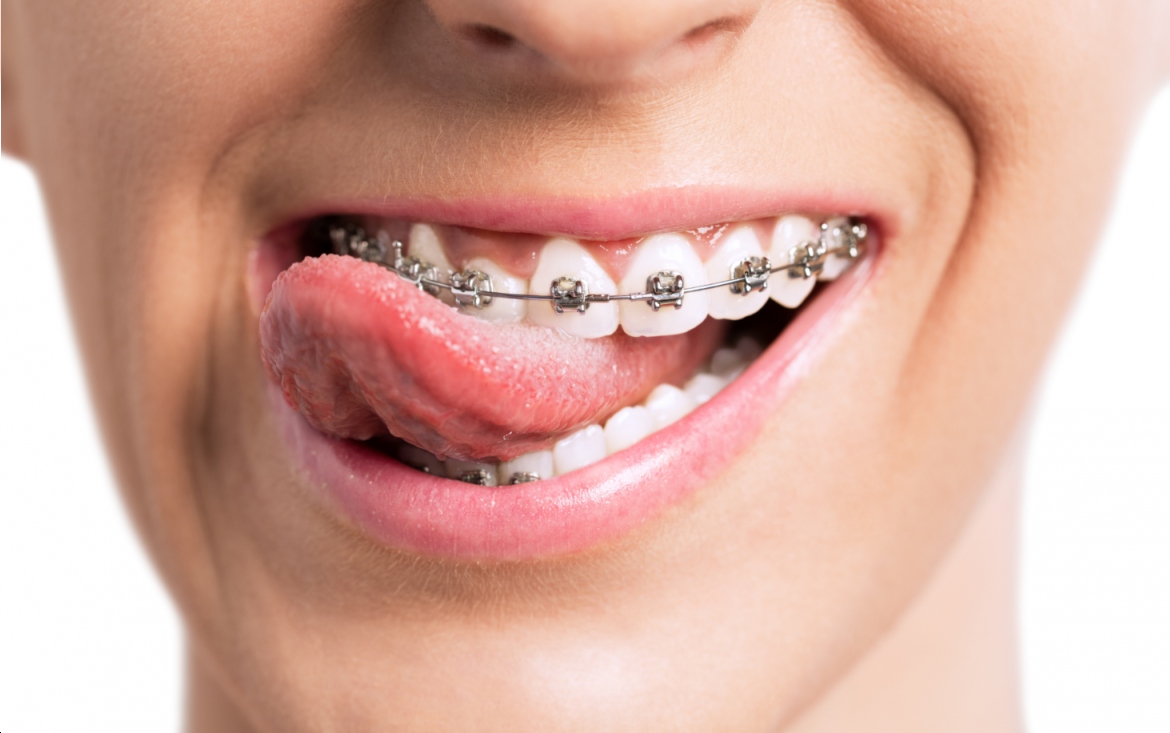 aparat ortodontyczny