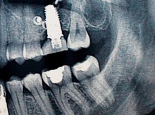 RTG zębów