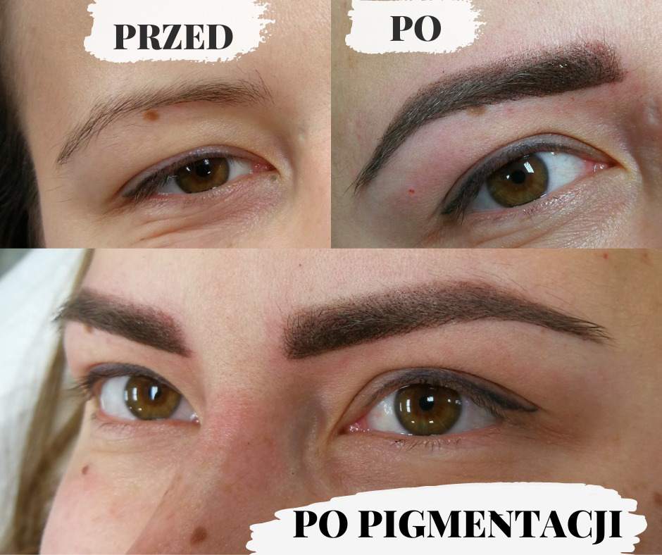 przed i po pigmentacji