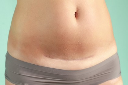 terapia blizn po cesarskim cięciu