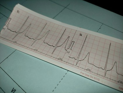 wynik EKG