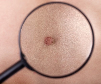 Diagnostyka i leczenie nowotworów skóry