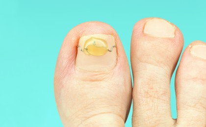 klamra na wrastający paznokieć