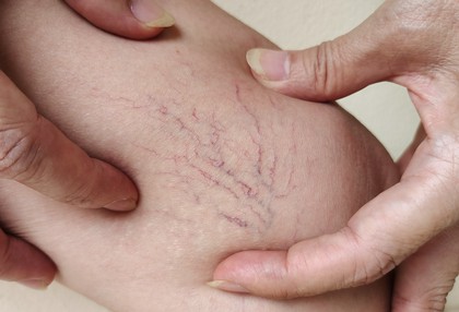 skleroterapia żylaków